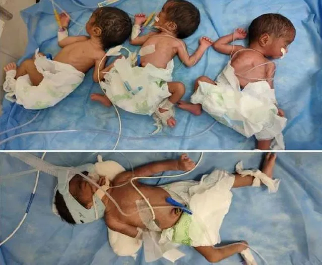 गोरखपुर: कोरोना संक्रमित महिला ने चार बच्चों को दिया जन्म
