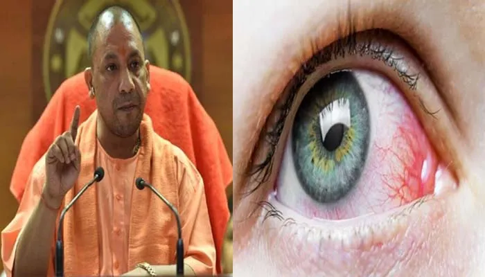 यूपी: ब्लैक फंगस बीमारी के उपचार के लिए आज जारी हो सकती है आवश्यक गाइडलाइंस