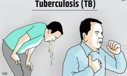 बरेली: आज से घर-घर खोजे जाएंगे क्षय रोगी