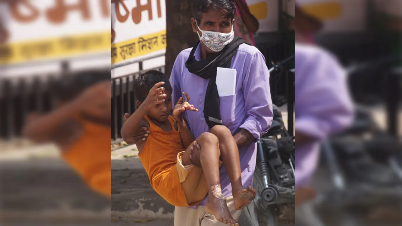 बरेली: संवेदनहीन कर्मचारी, दर्द से कराह रहे झुलसे बच्चे की कर दी अस्पताल से छुट्टी