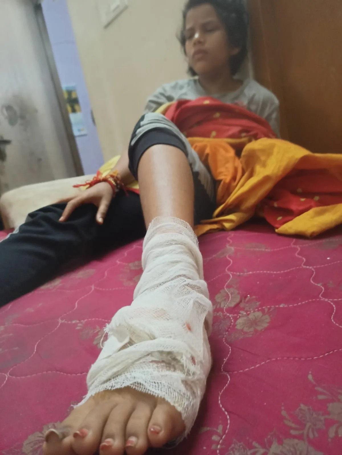 बरेली: घर में घुसकर पार्षद की बेटी पर कुत्तों का हमला, पैर नोचा