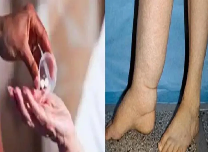 बरेली: जिले में 12 लाख लोगों ने खाई फाइलेरिया की दवा
