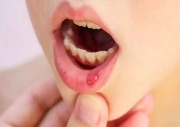 Mouth Ulcers: मुंह के छाले कर रहे हो परेशान तो करें ये घरेलू उपाय
