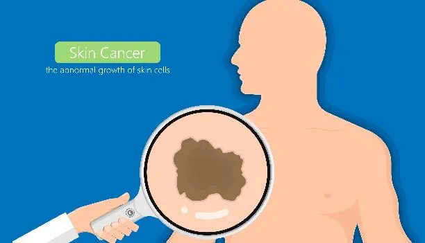 बरेली: त्वचा संबंधी बीमारियाों की अनदेखी से कैंसर का खतरा ज्यादा