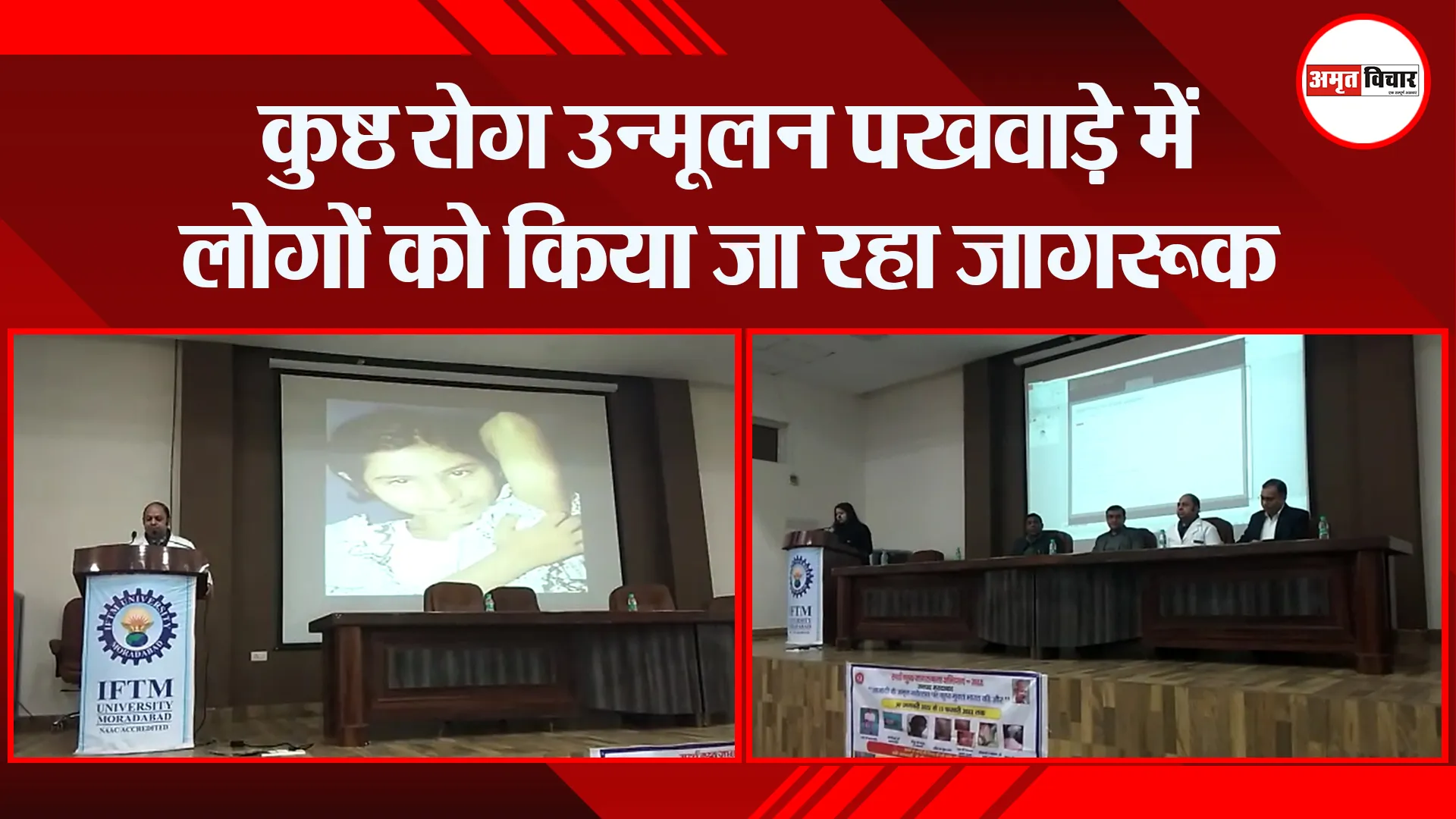 मुरादाबाद: कुष्ठ रोग उन्मूलन पखवाड़े में लोगों को किया जा रहा जागरूक