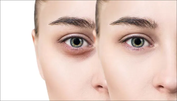 Dark Circles Removal: काले घेरों से छुटकारा पाना है तो अपनाएं यह घरेलू उपाय