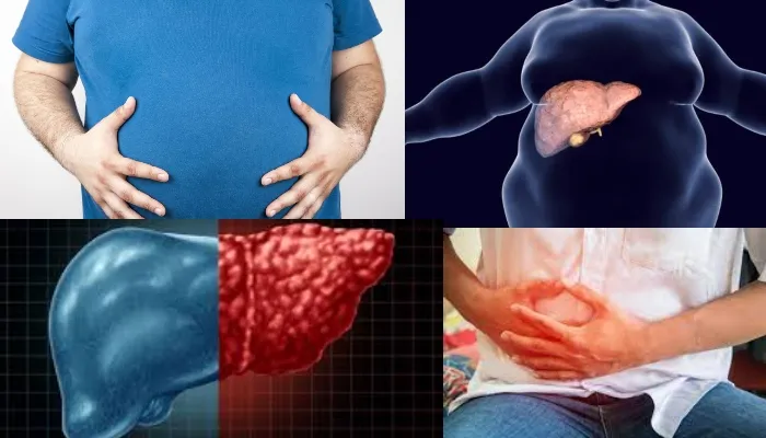 Fatty Liver Disease: फैटी लिवर होने पर इन बातों का रखें ध्यान, जल्द मिलेगा आराम