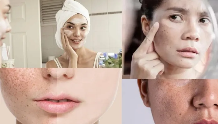 Pigmentation Remedies: स्किन प्रॉब्लम से पाएं आसानी से छुटकारा, अपनाएं यह घरेलू तरीके और पाएं ग्लोइंग फेस