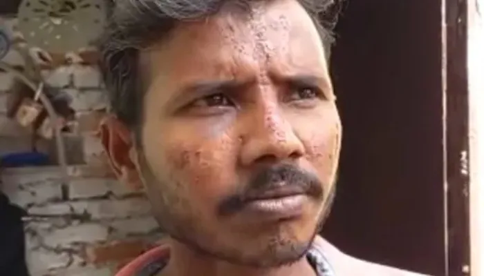 सहारनपुर: दबंग ने नशे में युवक के माथे पर तेजाब से बनाया त्रिशूल, पुलिस ने कहा-आरोप झूठे हैं