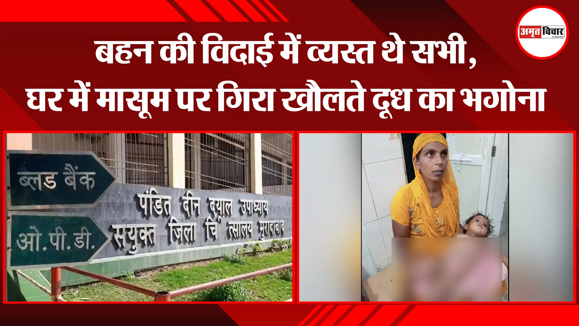 मुरादाबाद: बहन की विदाई में व्यस्त थे सभी, घर में मासूम पर गिरा खौलते दूध का भगोना