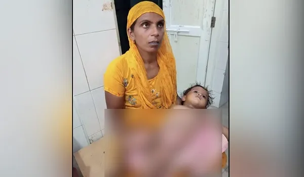मुरादाबाद : गर्म दूध गिरने से झुलसा बच्चा, हालत गंभीर