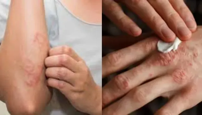 Skin fungal infection: स्किन पर होते हैं यह भयानक फंगल इंफेक्शन, ऐसे करें उपचार