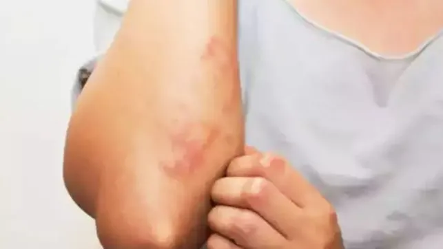 बरेली: गर्मी के प्रकोप ने बढ़ा दिए त्वचा रोगी, करें बचाव