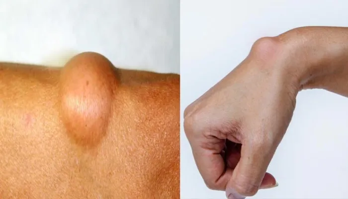 शरीर में चर्बी की गांठ को ना करें नजरअंदाज, निजात पाने के लिए अपनाएं यह घरेलू नुस्खे