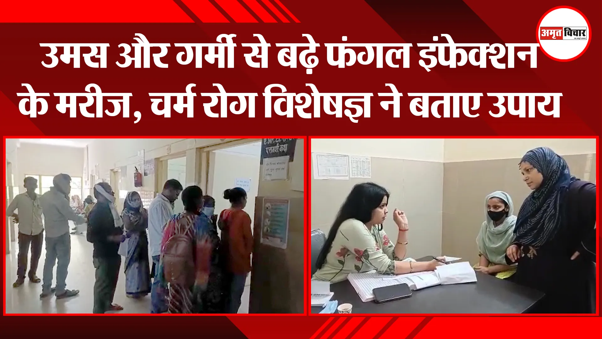 उन्नाव: उमस और गर्मी से बढ़े फंगल इंफेक्शन के मरीज, चर्म रोग विशेषज्ञ ने बताए उपाय