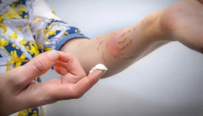 किचन में खाना बनाते वक्त Skin Burn होने पर अपनाएं यह घरेलू नुस्खे, मिलेगी जलन से राहत