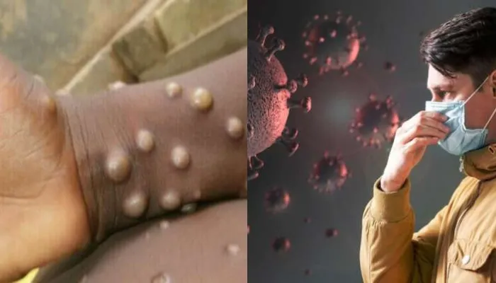 Monkeypox virus: शरीर में दिख रहे हैं यह लक्षण, तो इन जांचों से लगाये वायरस का पता