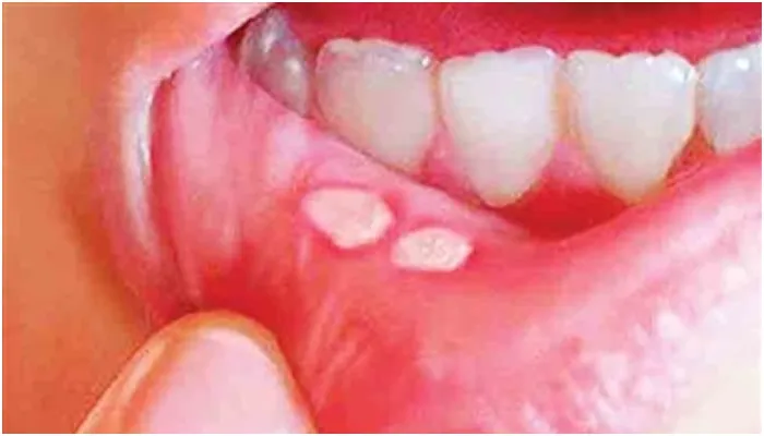 मुंह के छाले और दर्द से हैं परेशान तो अपनाएं यह घरेलू उपाय, जल्द मिलेगी राहत