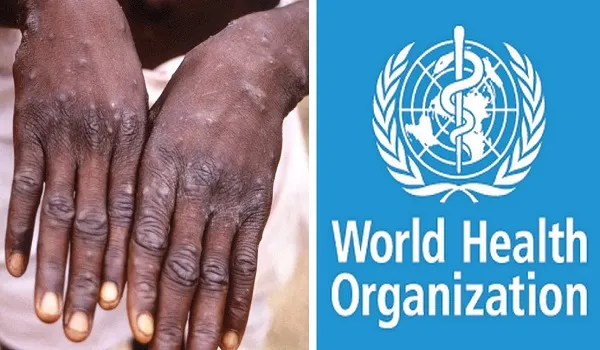 Monkeypox outbreak : डब्ल्यूएचओ ने कहा- मंकीपॉक्स को अभी वैश्विक स्वास्थ्य आपातकाल घोषित करने की जरूरत नहीं