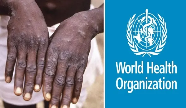MonkeyPox : मंकीपॉक्स का नया नाम रखने पर विचार कर रहा डब्ल्यूएचओ