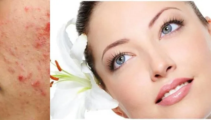 कील-मुंहासों से पाना चाहते हैं छुटकारा, तो अपनाएं यह घरेलू उपाय, चेहरे में आएगा निखार