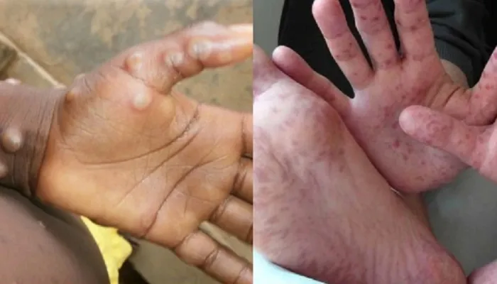 स्पेन में मंकीपॉक्स के 12 नए मामलों की पुष्टि, संख्या बढ़कर 132 हुई