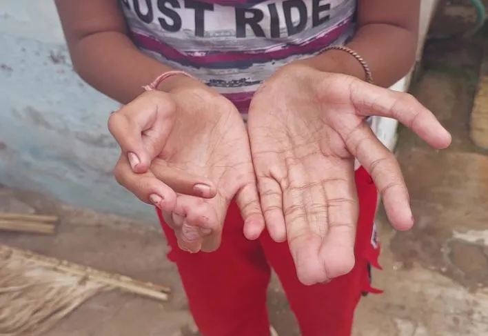 Polydactyly : MP में एक शख्स और 3 बच्चों को दुर्लभ बीमारी, हाथ-पैर में 28 उंगलियां