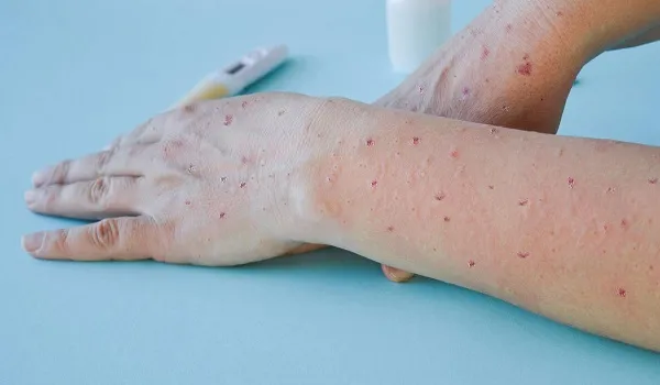 अमेरिका : न्यूयॉर्क में मंकीपॉक्स हेल्थ इमरजेंसी घोषित, अब तक दर्ज किए गए संक्रमण के 1,383 मामले