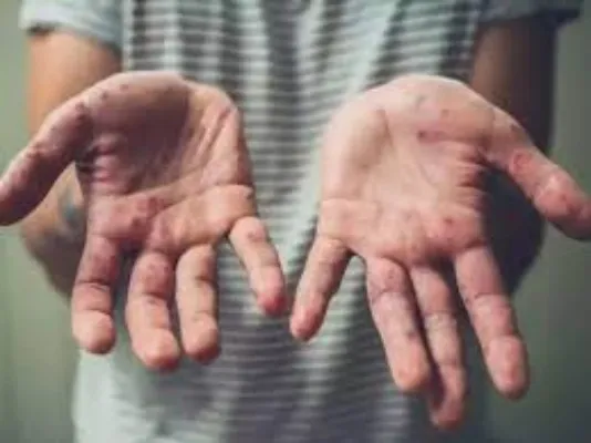 कानपुर : मंकीपॉक्स को लेकर अलर्ट पर स्वास्थ्य विभाग, विदेश से लौटे 117 लोग कराए गए आइसोलेट