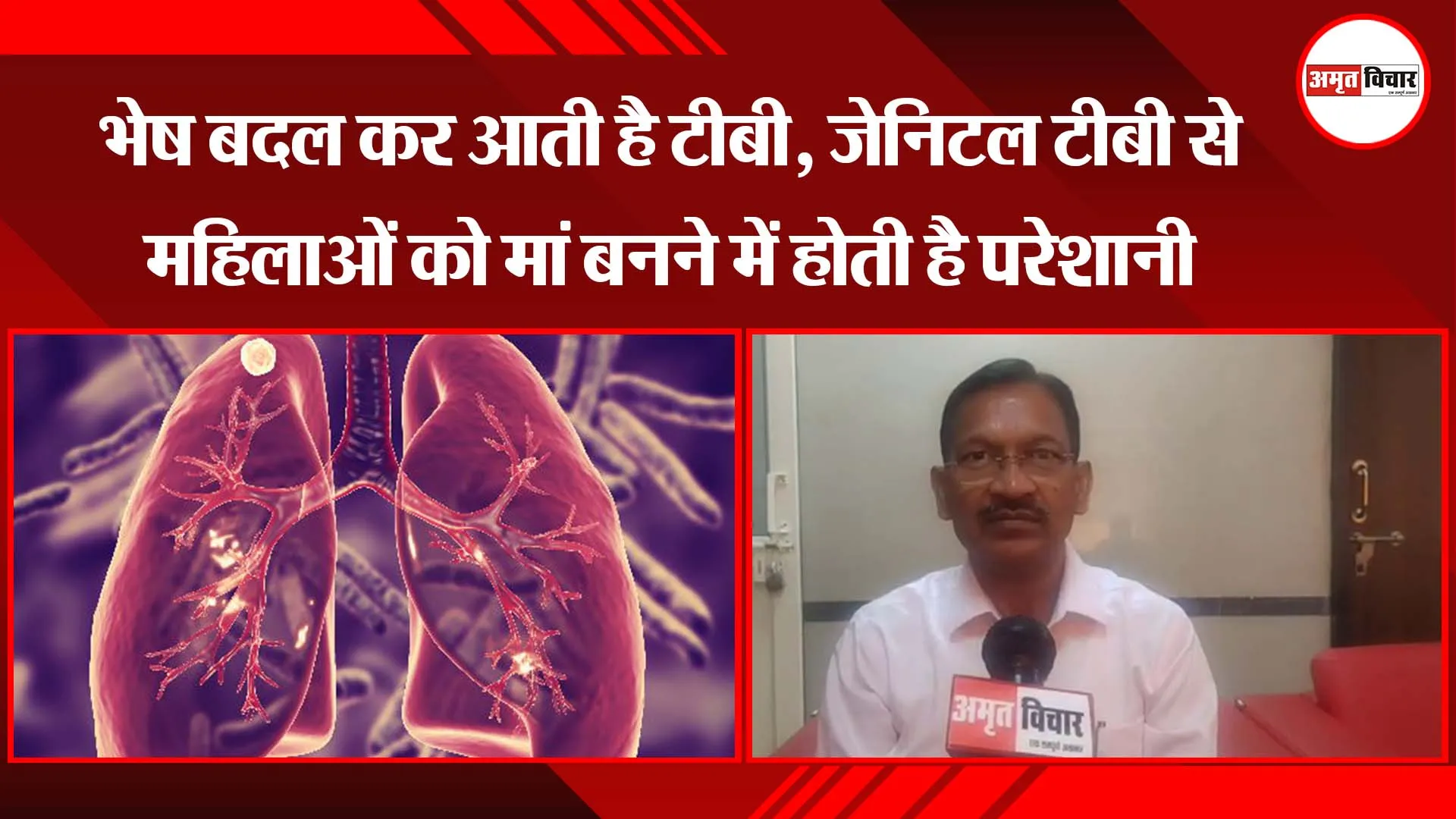 लखनऊ: भेष बदल कर आती है टीबी, जेनिटल टीबी से महिलाओं को मां बनने में होती है परेशानी