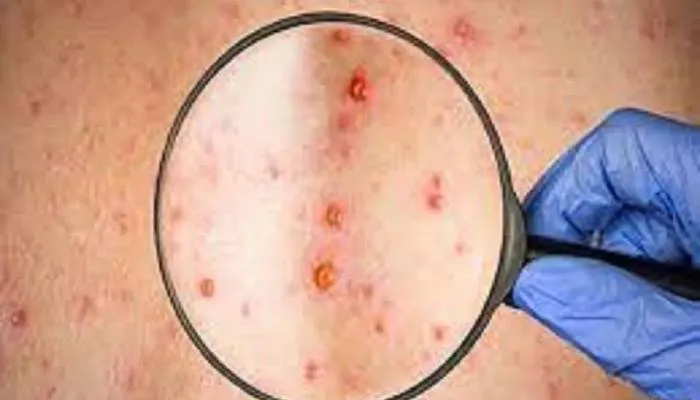 Monkeypox: औरैया में महिला में ‘मंकी पॉक्स’ जैसे लक्षण मिलने से हड़कंप, सैंपल भेजा गया लखनऊ