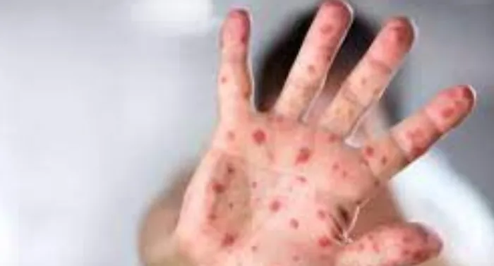 प्रयागराज: मंकीपॉक्स वायरस को लेकर CMO ने कहा- लक्षण दिखने पर ना करें इग्नोर गंभीरता से कराएं इलाज