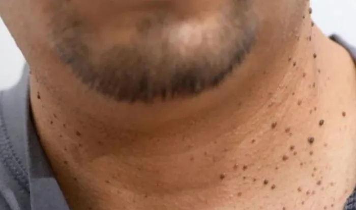 शरीर में किसी भी हिस्से में हो रहे मस्से, तो अपनाएं यह घरेलू उपाय