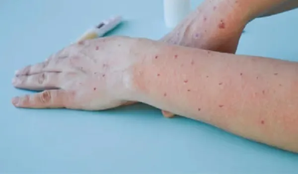 America: होंडुरास शहर में सामने आया मंकीपॉक्स का एक और मामला, जानें विश्व भर में संक्रमितों की संख्या