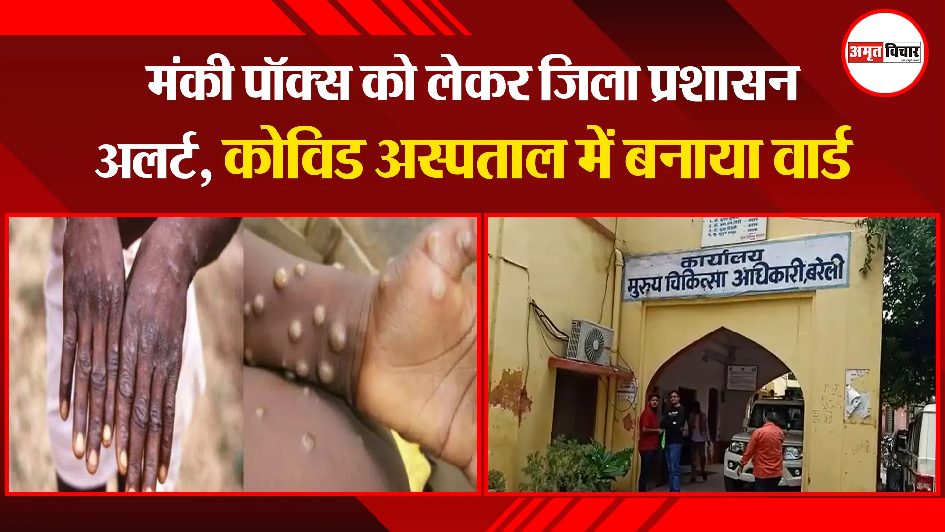 बरेली: मंकी पॉक्स को लेकर जिला प्रशासन अलर्ट, कोविड अस्पताल में बनाया वार्ड