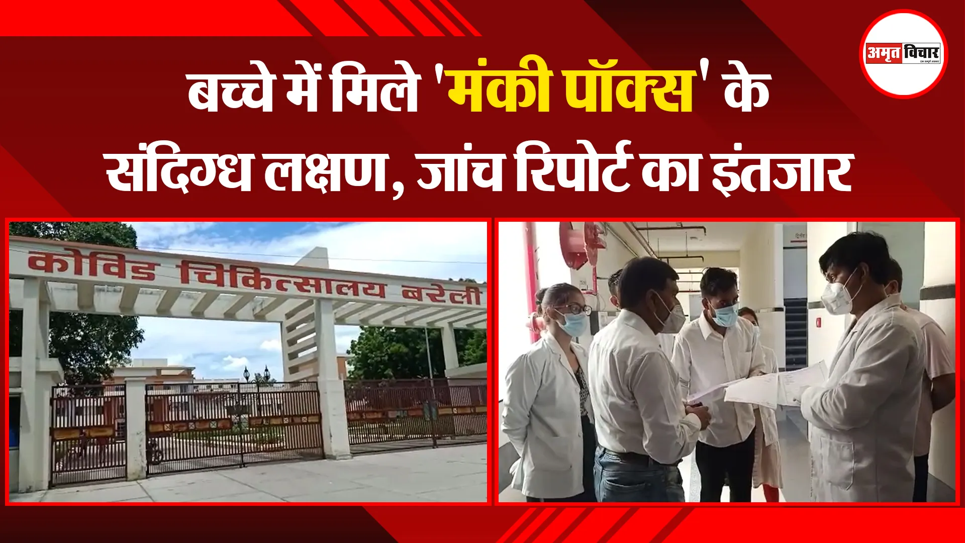 बरेली: बच्चे में मिले ‘मंकी पॉक्स’ के संदिग्ध लक्षण, जांच रिपोर्ट का इंतजार
