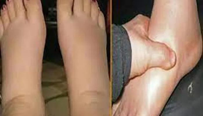 लखनऊ: अब सिर्फ एक दिन की ही दवा से होगा फाइलेरिया का इलाज