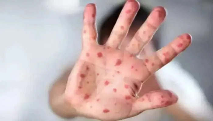 लखनऊ: टोमैटो फ्लू को लेकर स्वास्थ्य विभाग ने जारी की एडवाइजरी, कही यह बात