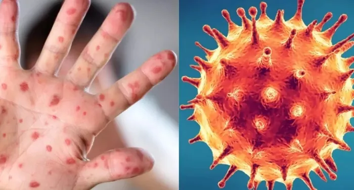 कोरोना वायरस के बीच मंकीपॉक्स का बढ़ रहा खतरा, दोनों वायरस में क्या है अन्तर, जानें