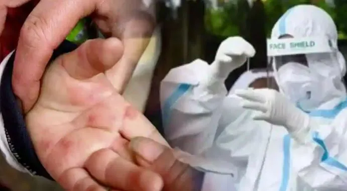 भारत में बढ़ा नई बीमारी का खतरा, Tomato Flu की जद में 5 साल तक के बच्चे, जानें इसके लक्षण और बचाव