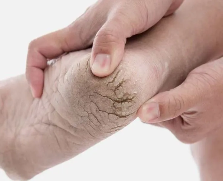 सर्दियों में अब नहीं फटेंगी आपकी एड़ियां, जान लें कारण और उपाय...
