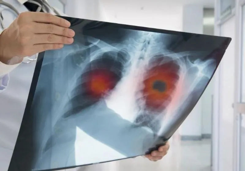 वायु प्रदूषण से फेफड़ों के कैंसर के मामलों में तेजी से इजाफा, 30 प्रतिशत महिलाएं शामिल