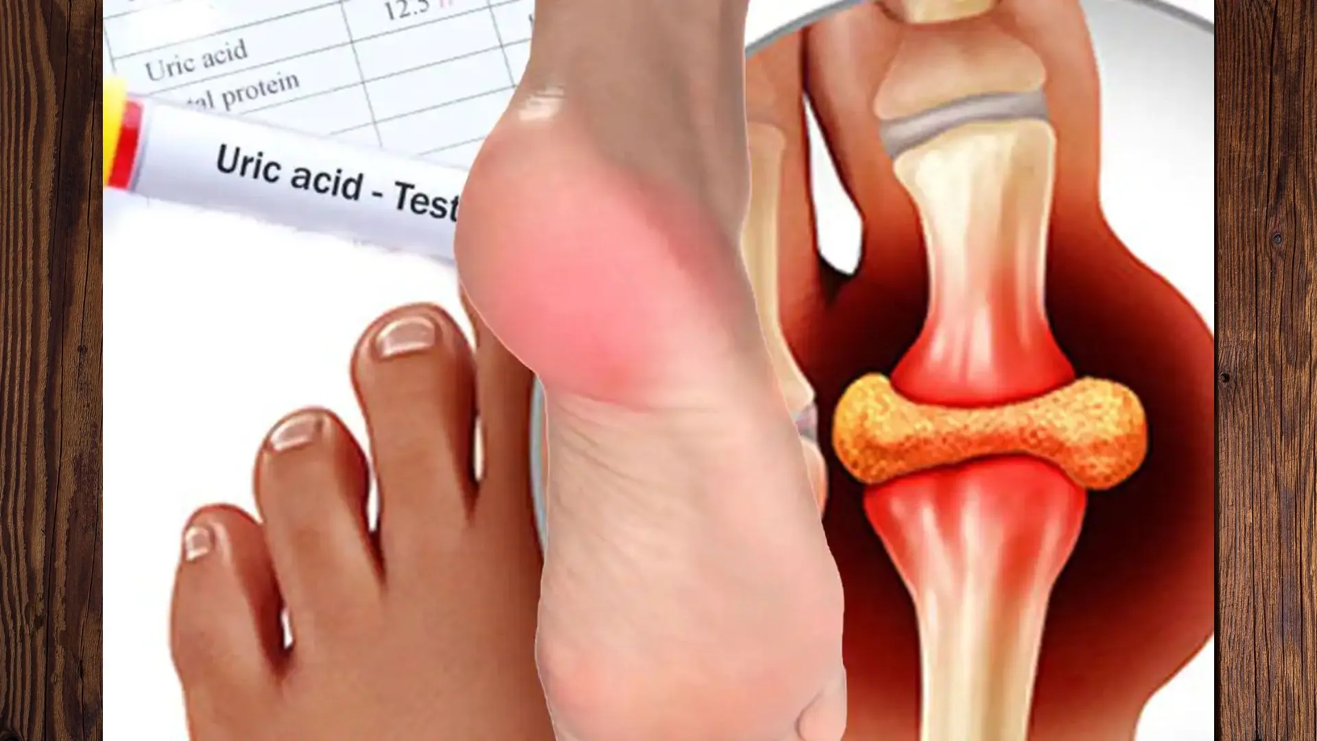 Uric Acid बढ़ने से हो सकती है गंभीर बीमारी, जानिए इसे कंट्रोल करने के घरेलू उपाय