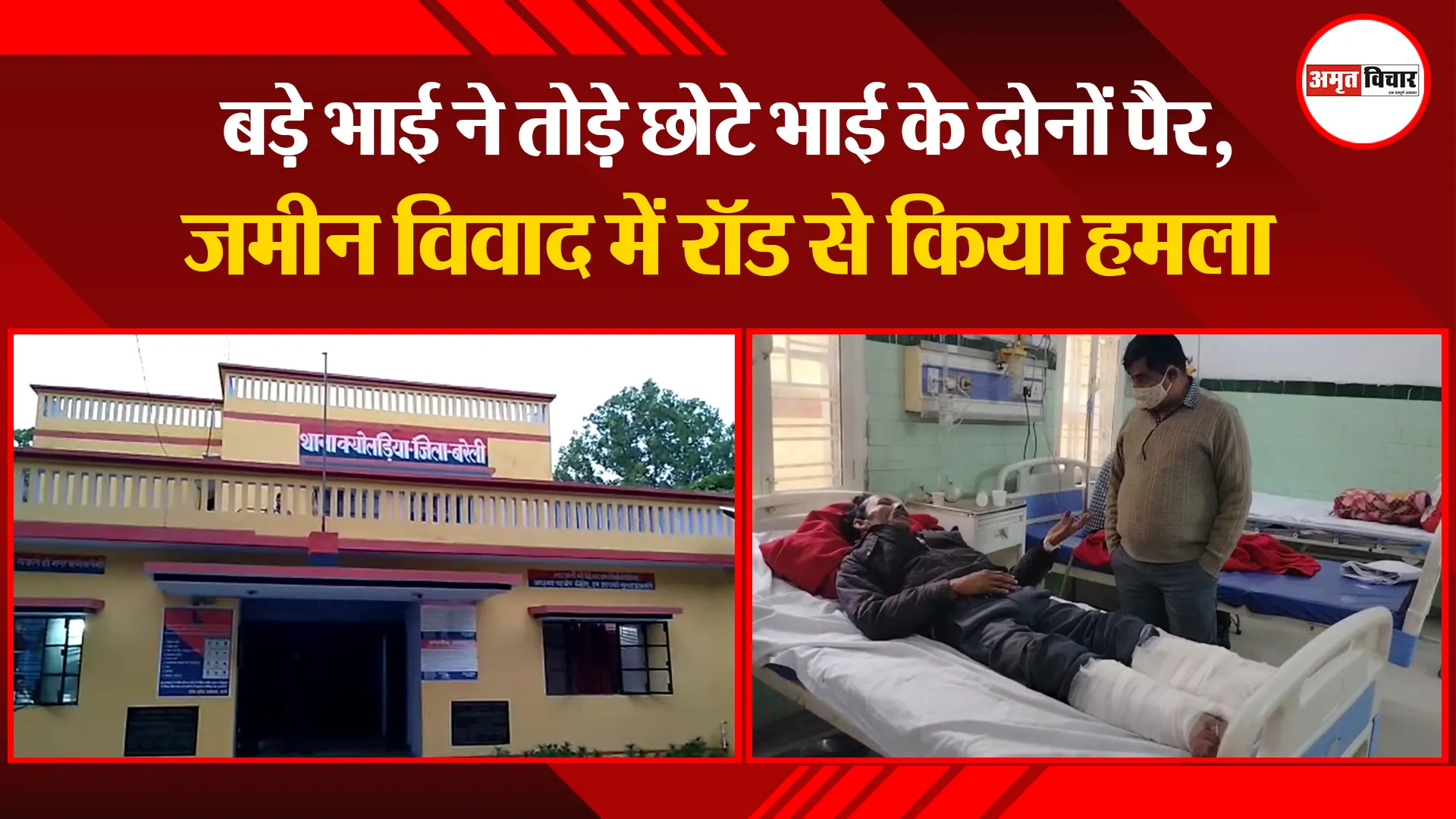 बरेली: बड़े भाई ने तोड़े छोटे भाई के दोनों पैर, जमीन विवाद में रॉड से किया हमला