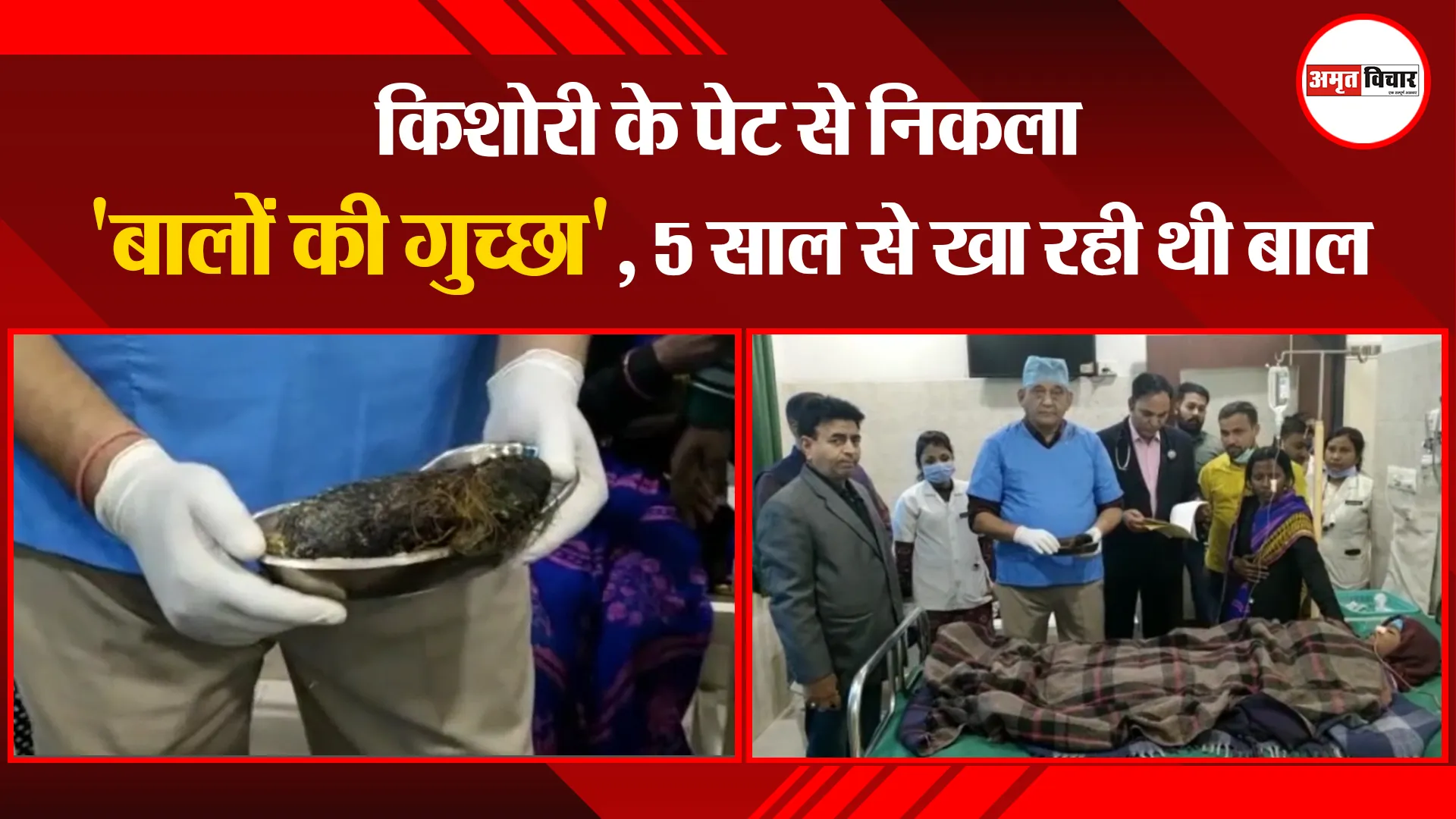 अयोध्या: किशोरी के पेट से निकला 'बालों की गुच्छा', 5 साल से खा रही थी बाल