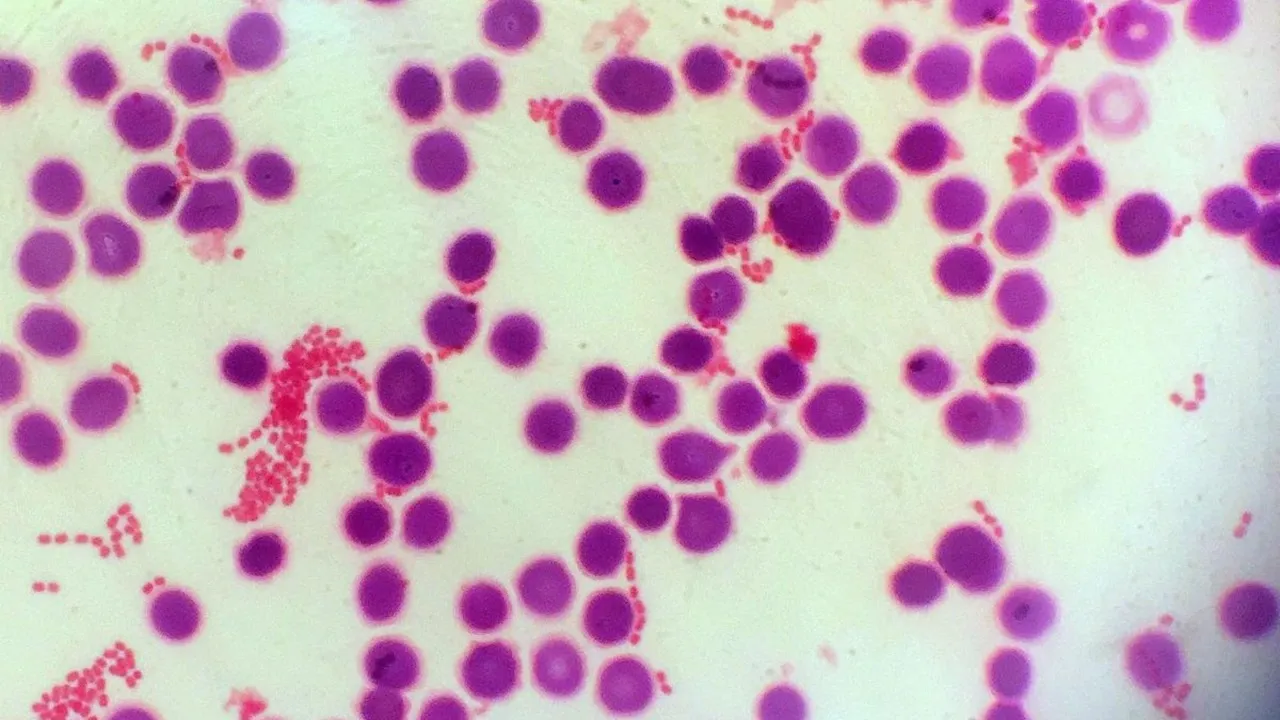Sepsis: दुनिया की सबसे विकट चिकित्सा स्थितियों में से एक सेप्सिस, कोशिका मृत्यु का बन सकता है कारण