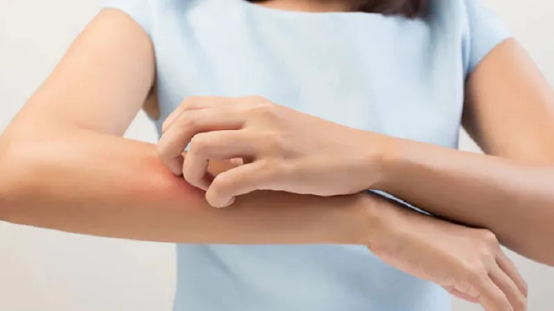 ठंड के मौसम में त्वचा पर खुजली, खुश्की और पपड़ी की स्थिति... कैसे करें उपचार ?