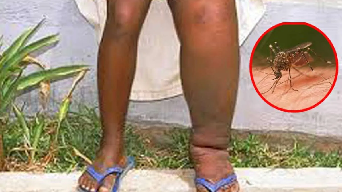 बरेली: डेंगू के बाद अब फाइलेरिया से होगी जंग, तैयारी पूरी