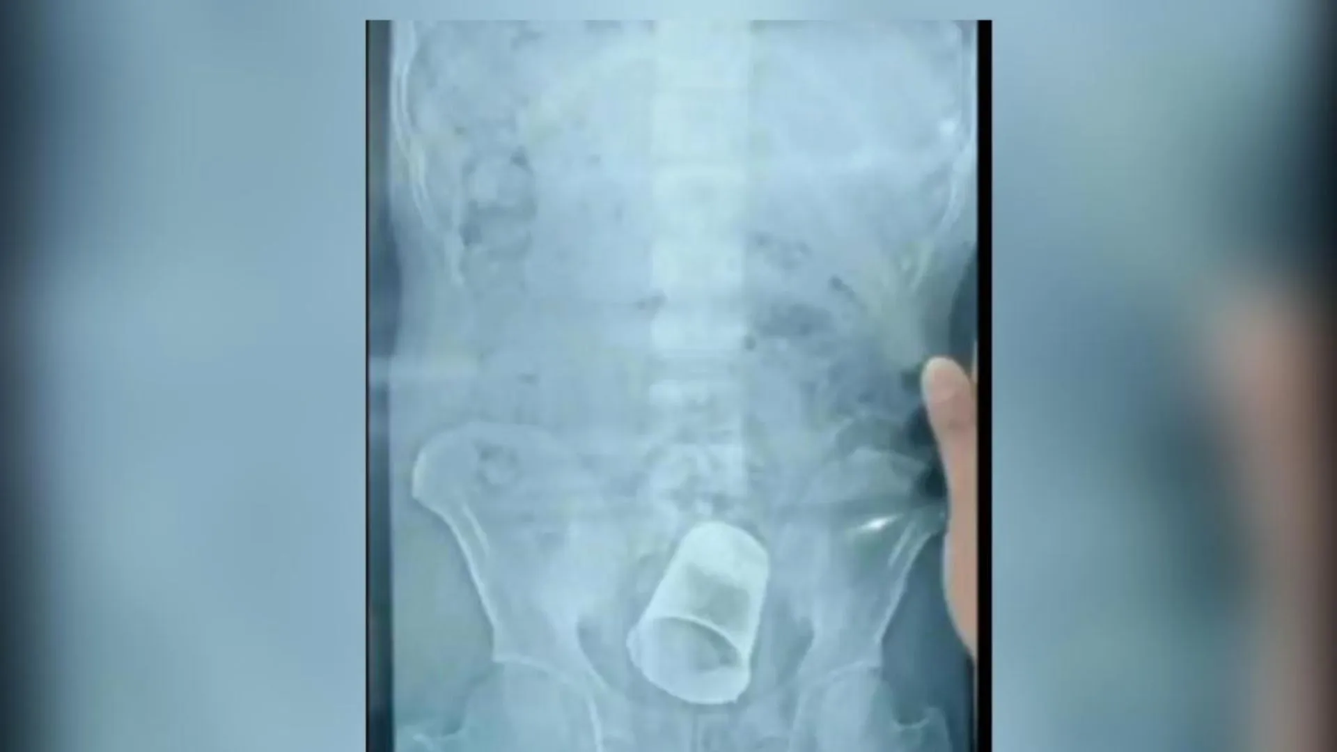 अमानवीय !  ससुरालवालों ने शख्स के प्राइवेट पार्ट में डाला स्टील का गिलास, एक्स-रे की तस्वीर आई सामने