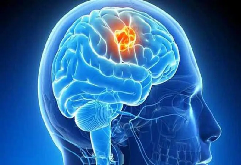 मूत्र की जांच से भी पता लगाया जा सकता है Brain Tumor, अध्ययन में हुआ खुलासा